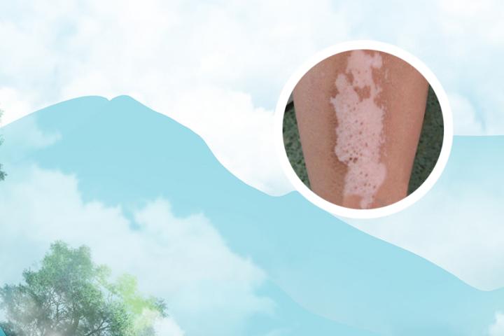 白癜风患者对花粉过敏吗