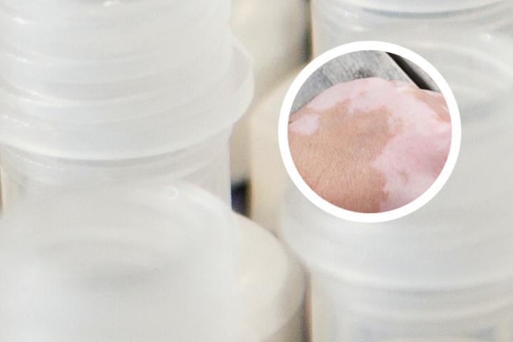 白癜风患者可以吃榴莲吗