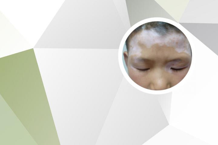 白癜风涂药时不能吃什么
