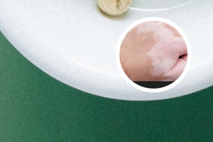 白癜风发了能吃牛奶鸡蛋吗