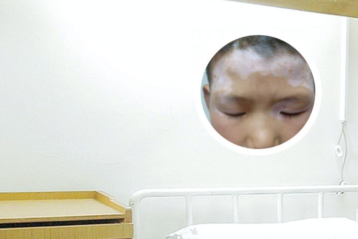 白癜风广东中医