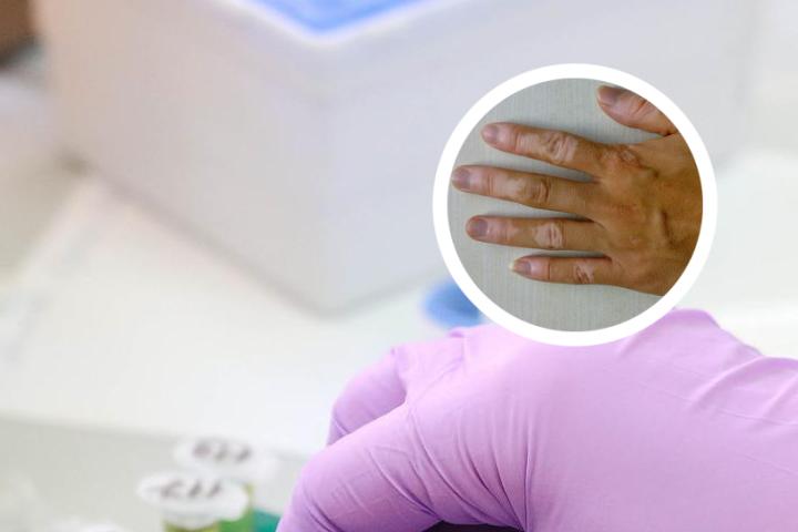白癜风光疗延长美甲价格