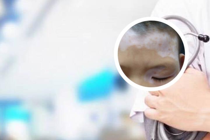 白癜风能用ve抹脸吗