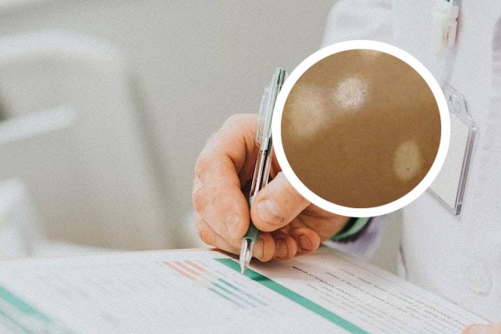 白癜风可以吃全鸡吗