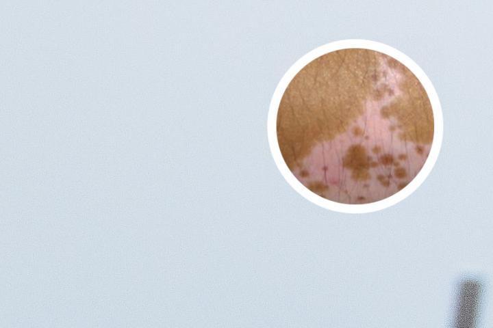 白癜风可以用艾叶泡脚吗