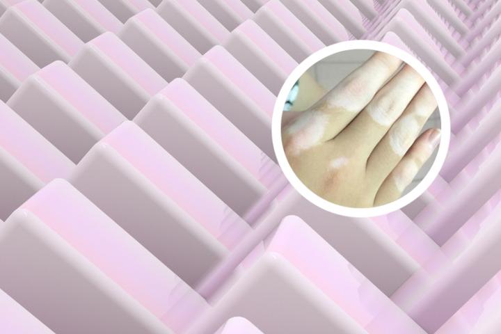18岁可以做白癜风检查吗