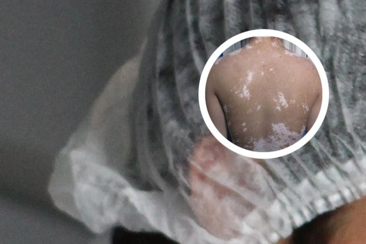 白癜风的食疗有哪些要注意的方面