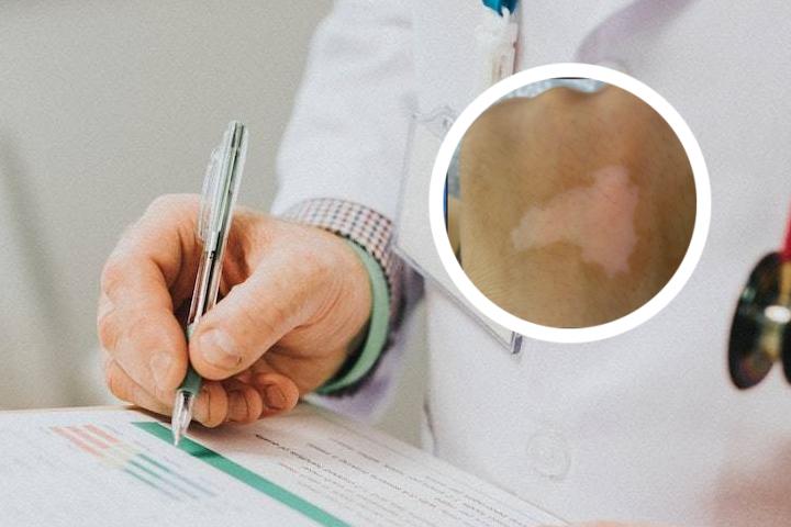白癜风病人白头发多
