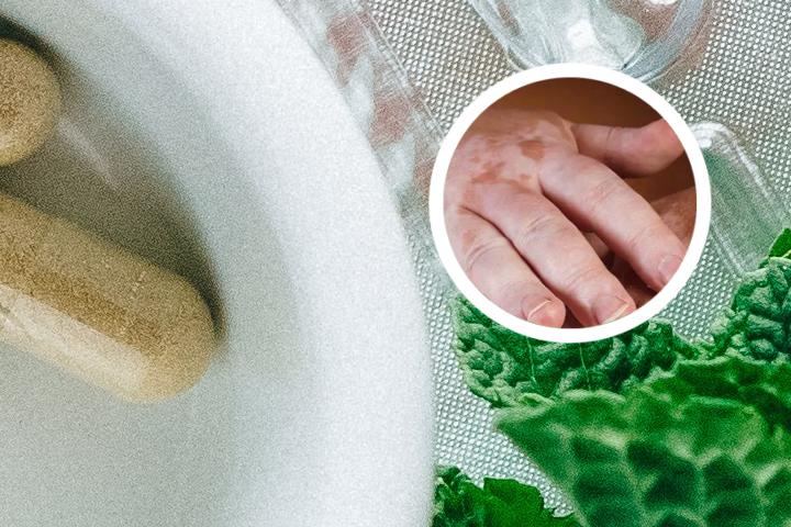 白癜风患者能吃茄子吗