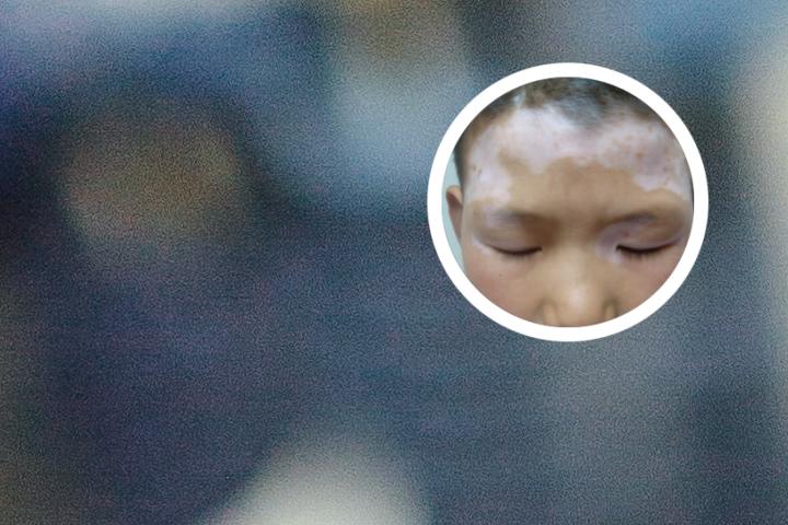 白癜风可以生正常小孩吗