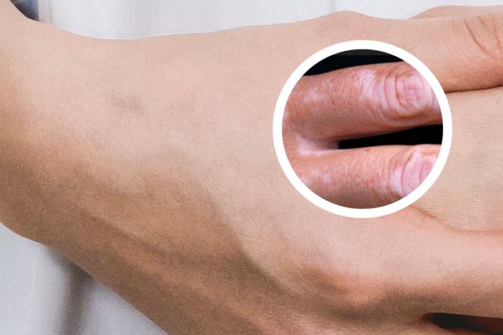 白癜风江萍