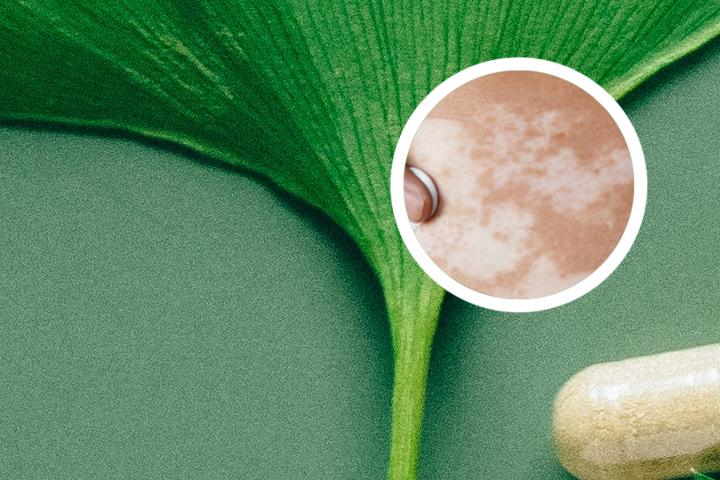 白癜风抹药后红痒脱皮正常吗