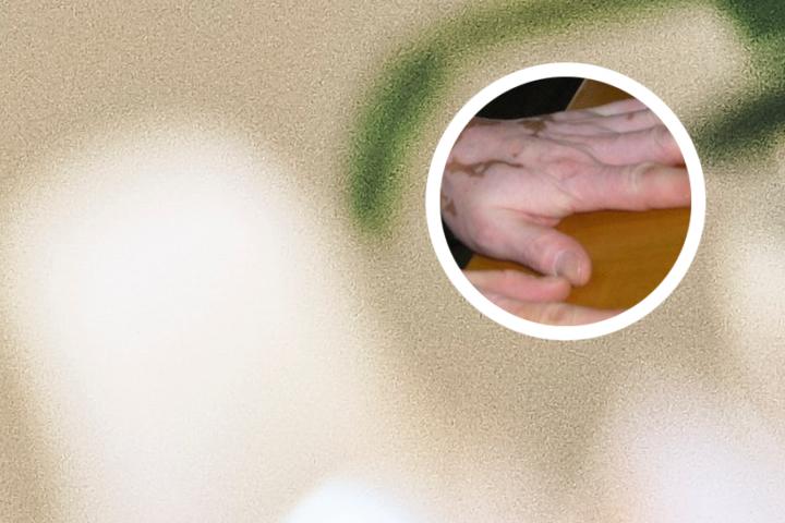 白癜风吃火锅的禁忌