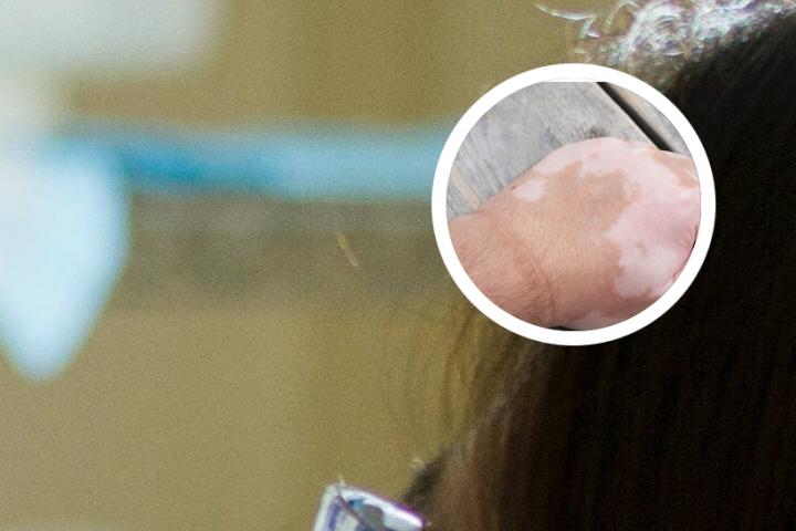 白癜风外用药哪款最好