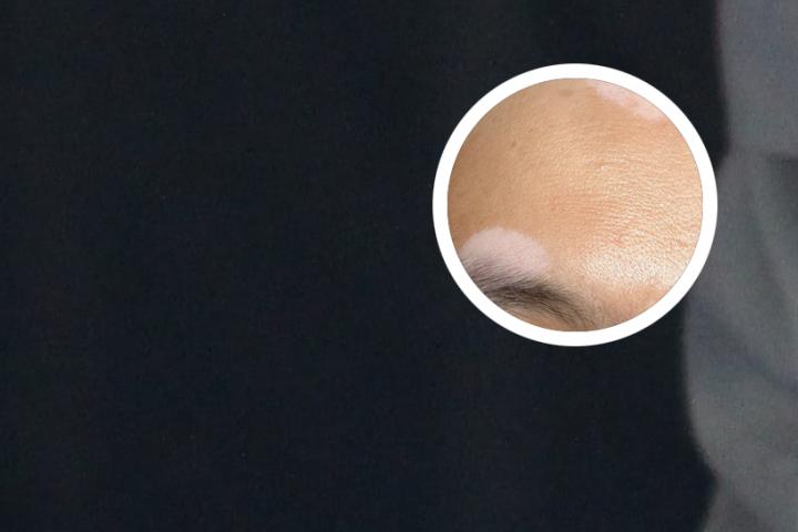 白癜风患者用凉水洗澡