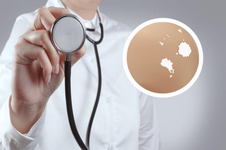 白癜风如何治便秘辅食过敏