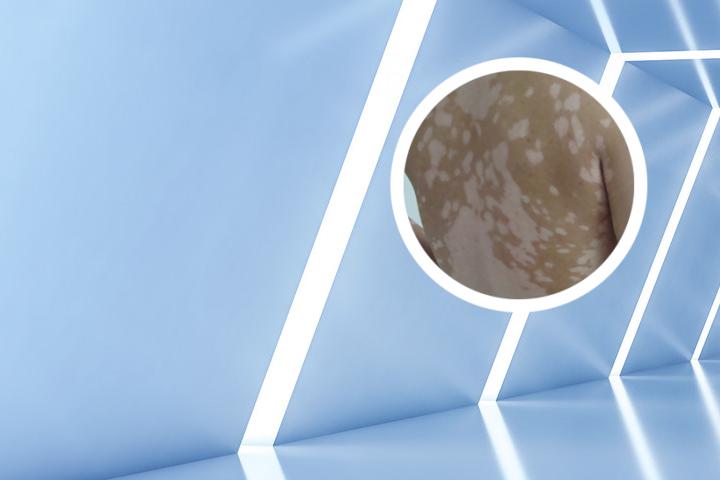 白癜风患者自述白斑瘙痒