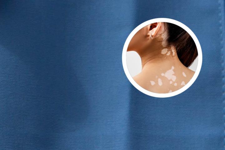 白癜风患者淡水鱼能吃吗