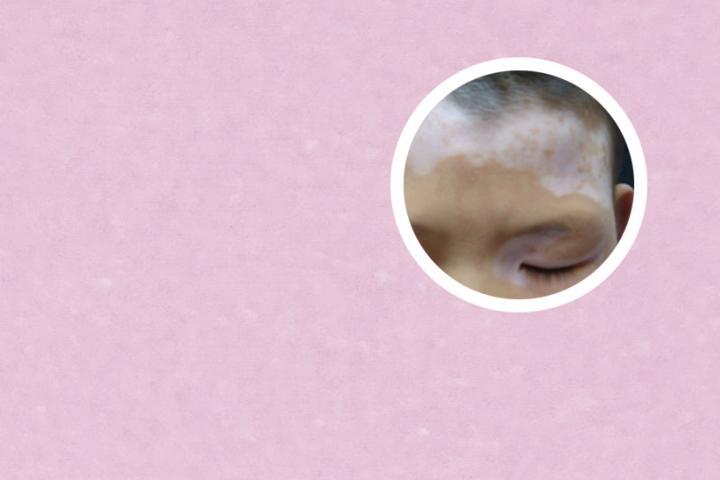 白癜风患者能喷美白喷雾吗