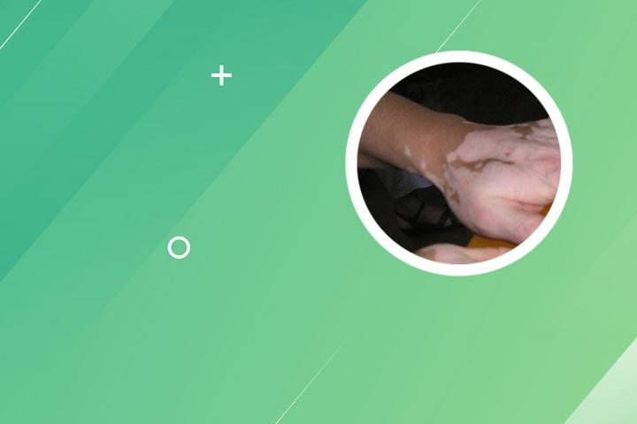 白癜风多久可以好