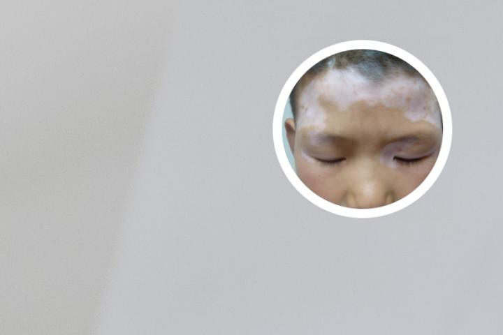 白癜风的危害怎么样