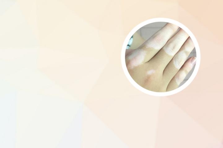 白癜风病人能吃黑米吗