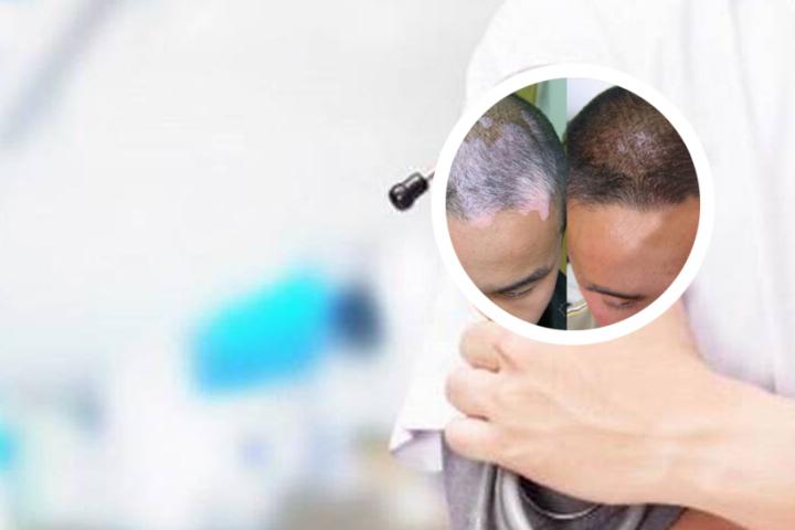 白癜风扩散跟纹身有关系吗