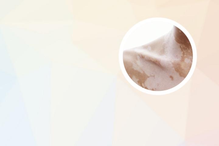 白癜风可以喝山羊奶吗