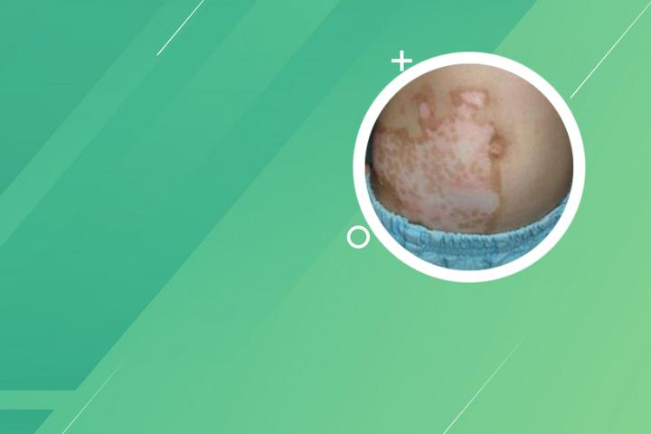 白癜风病人能做狐臭手术吗