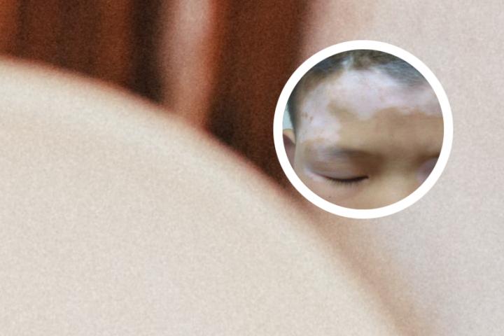 白癜风吃红糖姜片可以吗