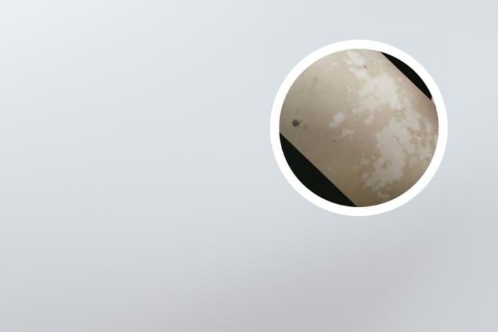 白癜风白斑周围变黑怎么办