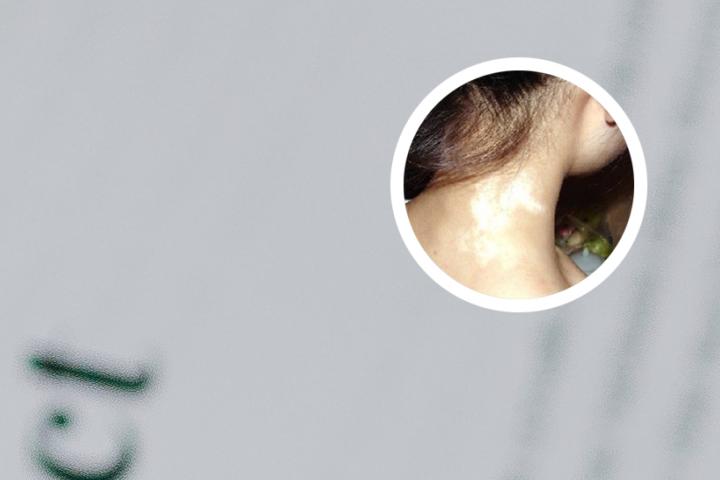 白癜风能吃螃蟹吗