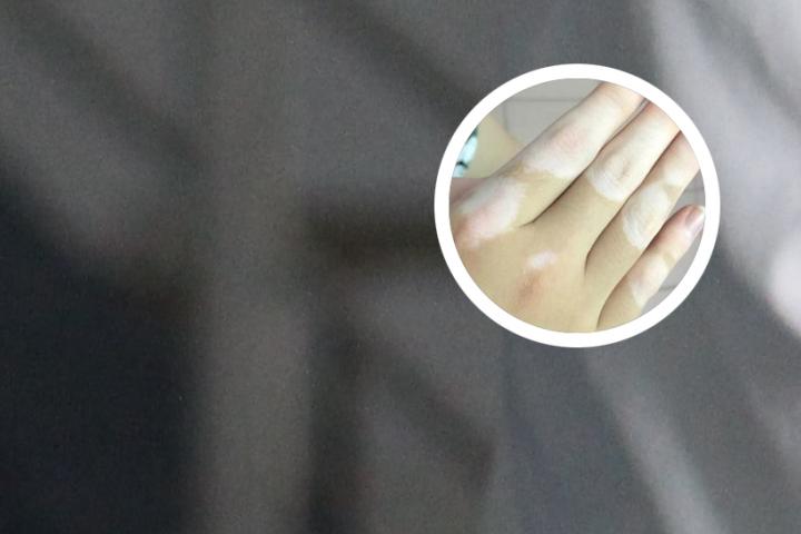 白癜风到医院怎么检查