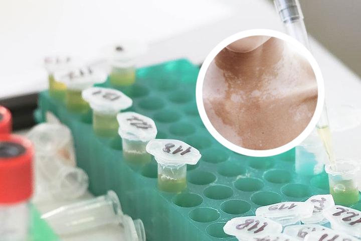 男生有白癜风可以要小孩吗
