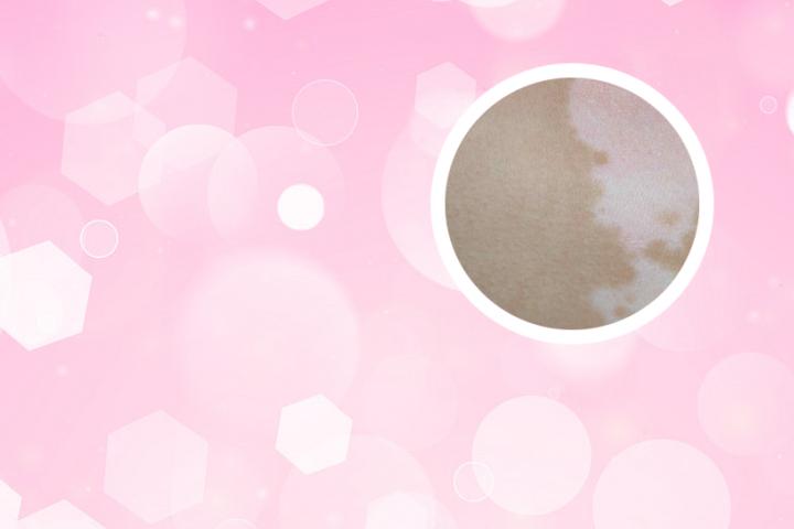 4个月婴儿会白癜风吗
