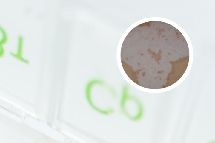 白癜风患者伤口疤痕是白癜风吗