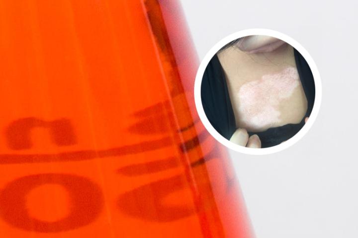 白癜风反复原因