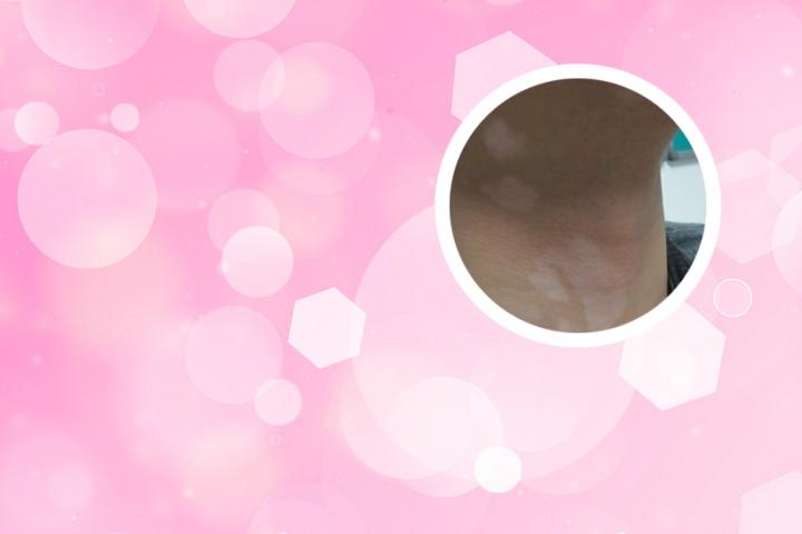 白癜风偶尔吃虾可以吗